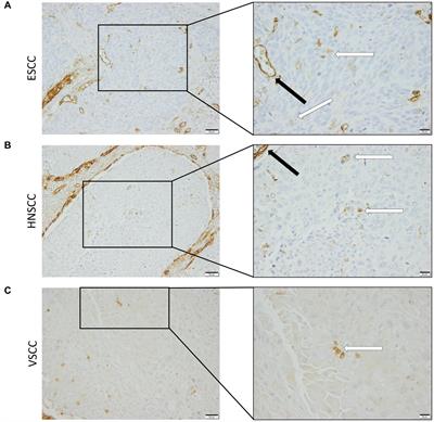Endoglin and squamous cell carcinomas